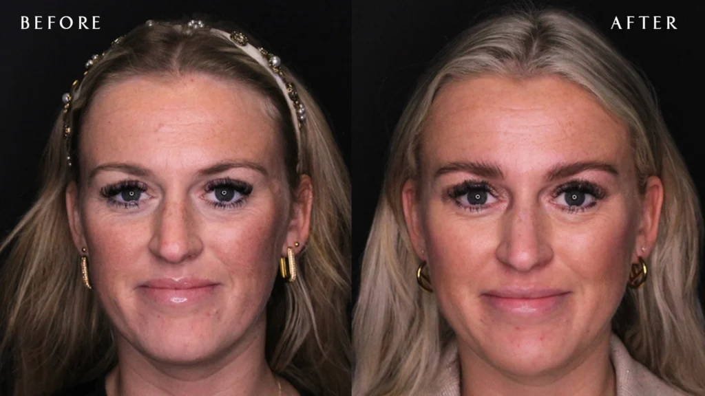 settletijd herstel tijd hyaluronzuur fillers