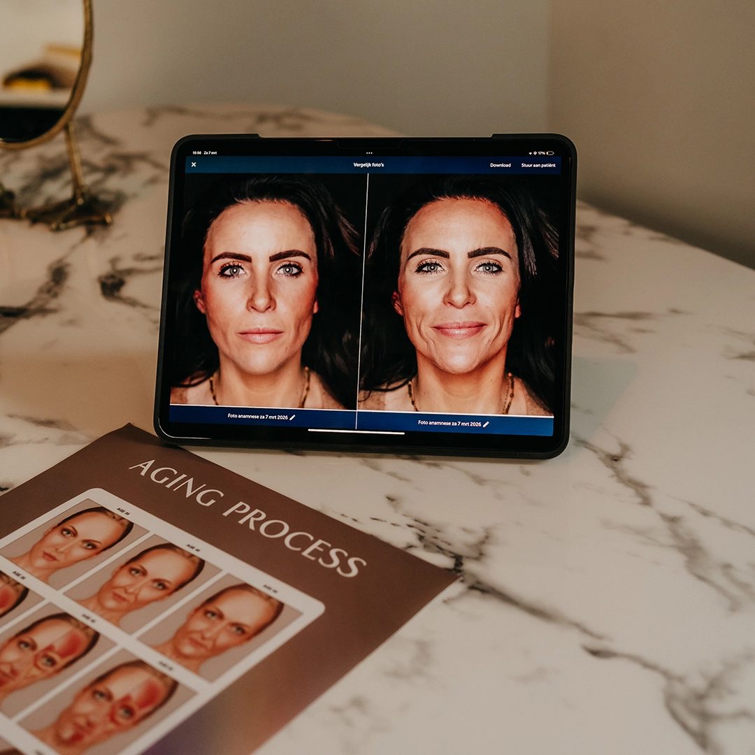 Easy Droxy peeling resultaat